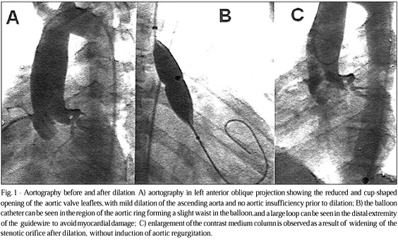 Short- and midterm follow-up results of valvuloplasty with balloon catheter for congenital aortic stenosis