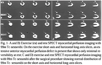 Anomalous origin of the left coronary artery from the pulmonary trunk in a 45-year-old woman