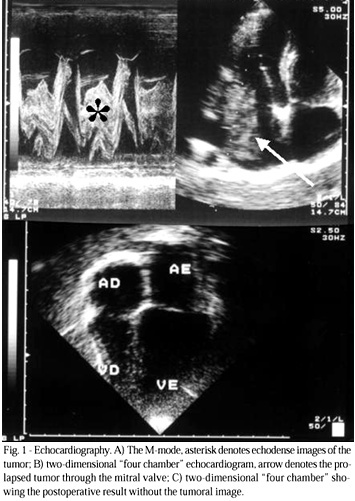 Left atrial myxoma as the cause of syncope in an adolescent