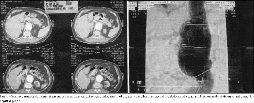 Aneurysmal dilation of the reimplant segment of the visceral vessels after thoracoabdominal aneurysm correction
