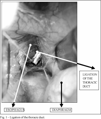 Ligation of the thoracic duct for the treatment of chylothorax in heart diseases