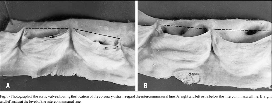Morphometric and topographic study of coronary ostia