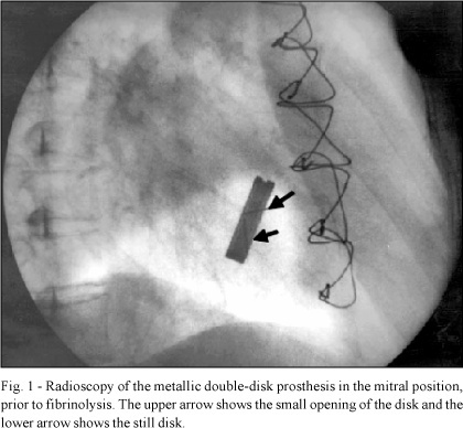 Fibrinolytic therapy for thrombosis in cardiac valvular prosthesis short and long term results