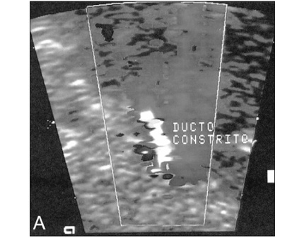 Intrauterine ductus arteriosus constriction: analysis of a historic cohort of 20 cases