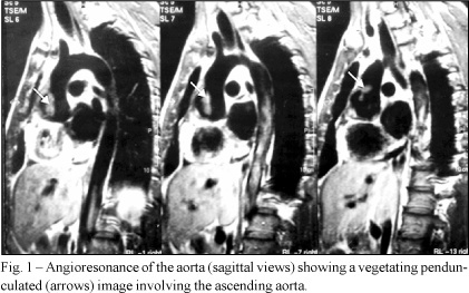 Aspergillus infection in the ascending aorta of a patient with aortic and mitral valve prostheses