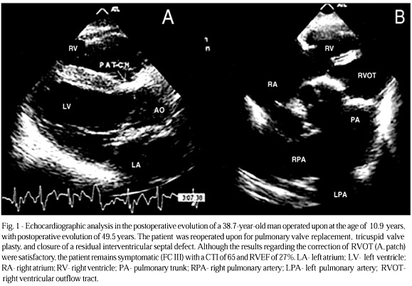 Right ventricular structure and function as possible determinants of surgical outcome 30 years after repair of tetralogy of Fallot