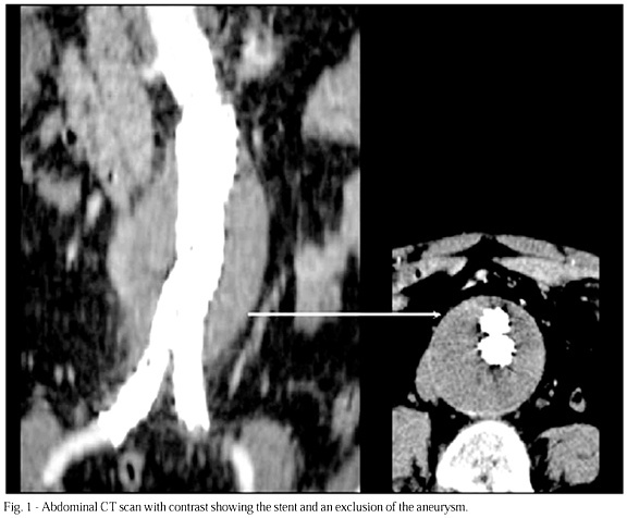 A change in the treatment of abdominal aortic aneurysms