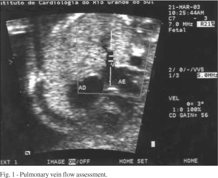Pulmonary vein pulsatility in fetuses of diabetic mothers: prenatal Doppler echocardiographic study