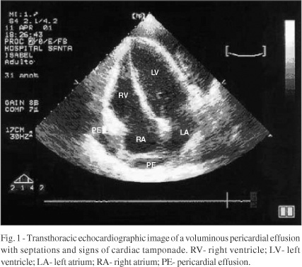 Spontaneous rupture of a right atrial angiosarcoma and cardiac tamponade