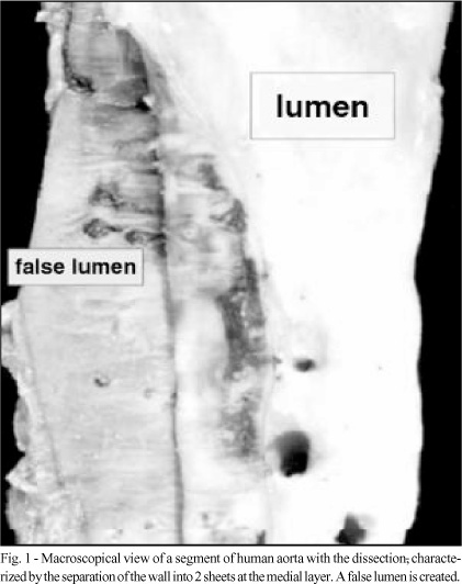 Thyroid hormone levels in patients with aortic dissection: comparison with controls and correlation with the percentage of the aortic media composed of myxoid deposits