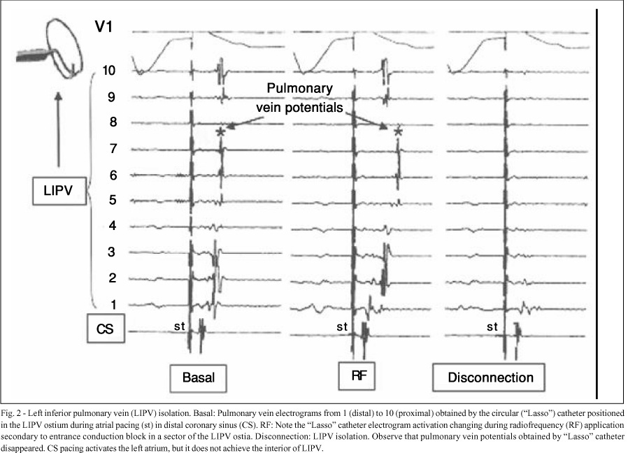 Pulmonary veins isolation to treat patients with refractory paroxysmal atrial fibrillation: clinical results after a single procedure