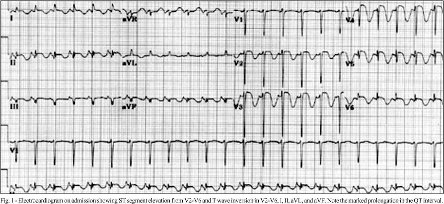 Pheochromocytoma-induced segmental myocardial dysfunction mimicking an acute myocardial infarction in a patient with normal coronary arteries