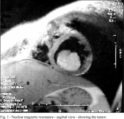 Left ventricular lipoma