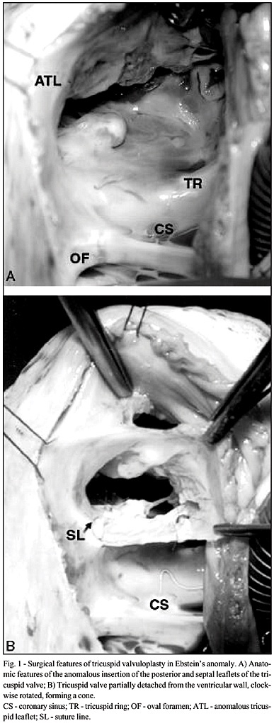 Ebstein's anomaly: results of the conic reconstruction of the tricuspid valve