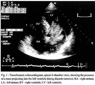 Left atrial myxoma: three-dimensional echocardiographic assessment