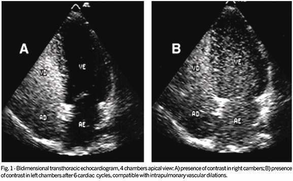 Contrast echocardiography in the diagnosis of intrapulmonary vascular dilations in patients eligible for liver transplantation