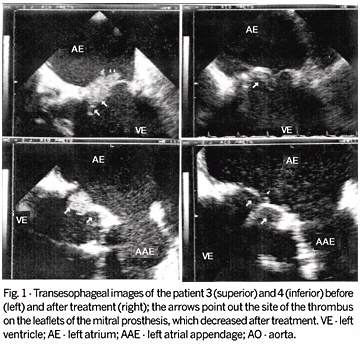 Bioprosthetic mitral valve thrombosis: importance of transesophageal echocardiography in the diagnosis and follow-up after treatment