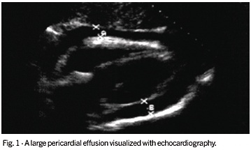 Pericarditis: series of 84 consecutive cases