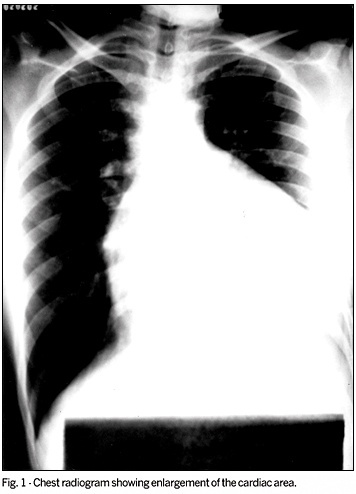 Isolated chylopericardium after cardiac surgery