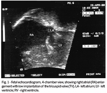 Intrauterine detection of Ebstein's anomaly and Down's syndrome: prenatal diagnosis of a rare combination