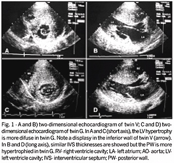 Hypertrophic cardiomyopathy in monozygotic twins