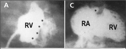 Angiographic morphologic characteristics in pulmonary atresia with intact ventricular septum