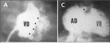 Características morfológicas angiográficas na atresia pulmonar com septo interventricular íntegro