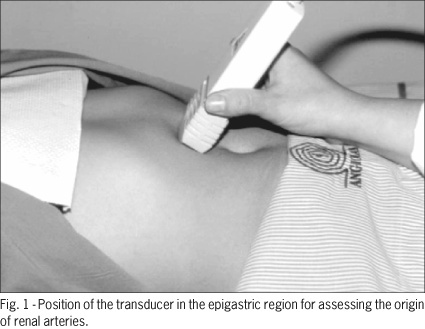 Vascular color Doppler ultrasound for assessing renovascular hypertension: accuracy of the direct technique for assessing the renal arteries