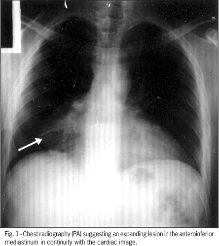 Chest pain due to right atrial compression caused by a thymolipoma