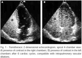 Contrast echocardiography in the diagnosis of intrapulmonary vascular dilations in candidates for liver transplantation