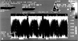 Severe volume depletion leading to mitral insufficiency
