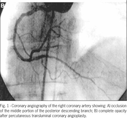 Inferior myocardial infarction and shock associated with left ventricular outflow tract obstruction