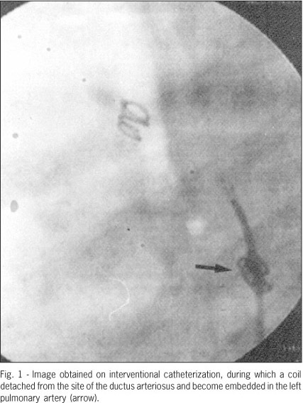 Surgical treatment of coil embolization to the pulmonary artery after an attempt at percutaneous closure of patent ductus arteriosus
