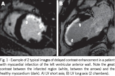 Quantification of left ventricular infarcted mass on cardiac magnetic resonance imaging: comparison between planimetry and the semiquantitative visual scoring method