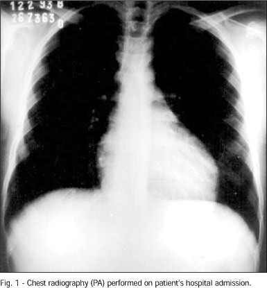 Generalized edema and hyperdynamic circulation: a possible case of beriberi