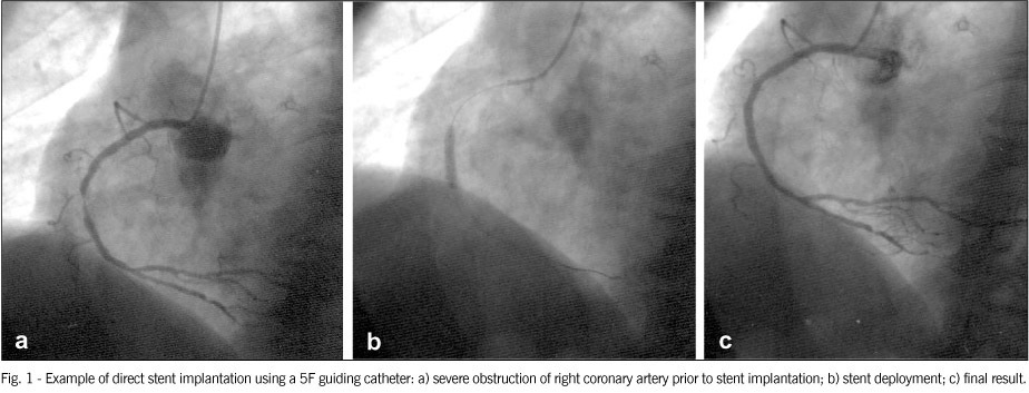 Direct stent implantation using a 5F guiding catheter and transradial approach