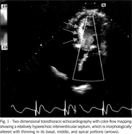 Severe mitral stenosis in the long-term evolution of myotomy-myectomy-septal resection