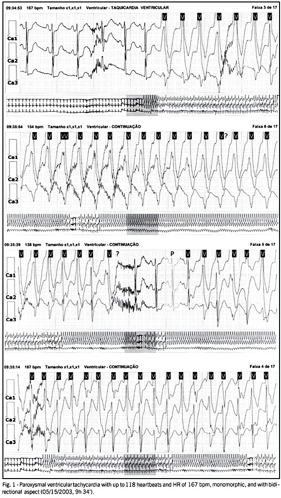 Acute myocarditis secondary to pheochromocytoma