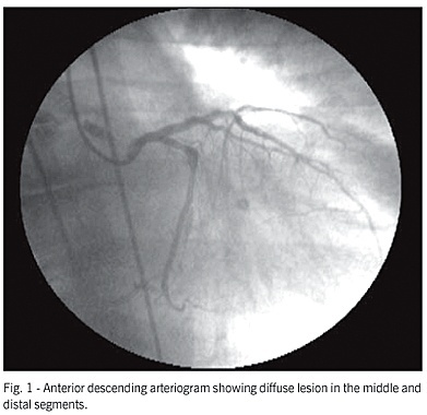 Stem cell therapy with retrograde coronary perfusion in acute myocardial infarction: a new technique