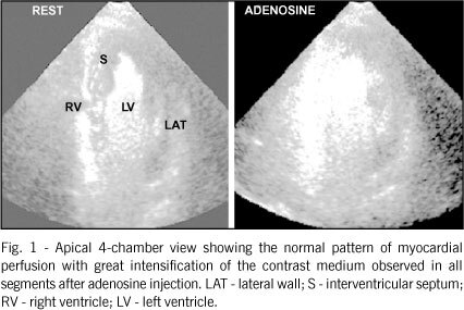 Myocardial contrast echocardiography in patients with suspected or known coronary artery disease: comparison with myocardial nuclear scintigraphy