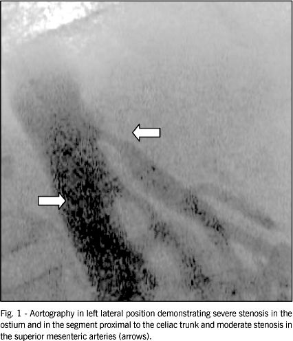Stent implantation in critical stenosis of the celiac trunk: enlarging the frontiers of percutaneous vascular intervention