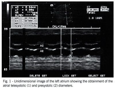 Study of global left atrial shortening in fetuses of diabetic mothers