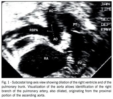 Anomalous origin of one pulmonary artery from the ascending aorta: surgical repair resolving pulmonary arterial hypertension