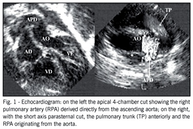 Surgical repair of the anomalous origin of the right pulmonary artery from the ascending aorta