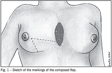 Use of a flap composed of skin and breast tissue for repairing a recalcitrant wound resulting from dehiscence of sternotomy in cardiac surgery