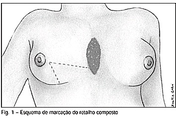 A utilização de retalho composto de pele e tecido mamário na reparação de área cruenta resultante da deiscência de esternotomia em cirurgia cardíaca