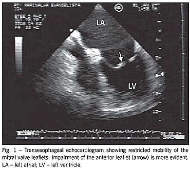 Doppler echocardiographic variables and the type of surgery to be performed in rheumatic mitral valve regurgitation