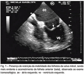 Variáveis Doppler-ecocardiográficas e o tipo de cirurgia a ser realizada na regurgitação valvar mitral reumática
