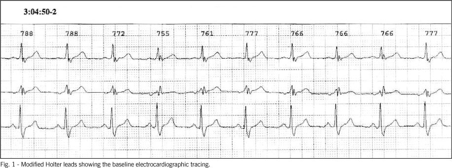 Acute myocardial infarction and documented sudden death