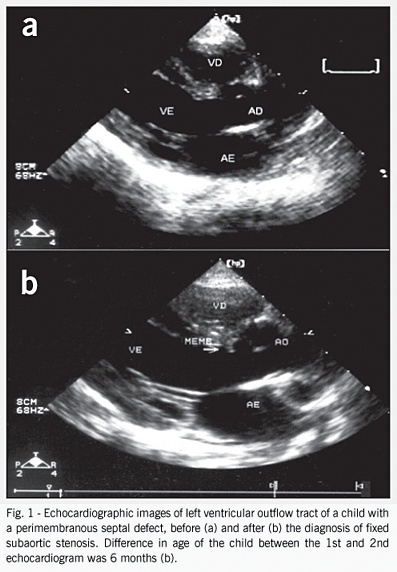 Subaortic stenosis associated with perimembranous ventricular septal defect: clinical follow-up of 36 patients